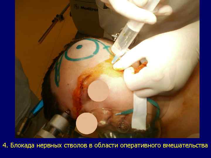 4. Блокада нервных стволов в области оперативного вмешательства 