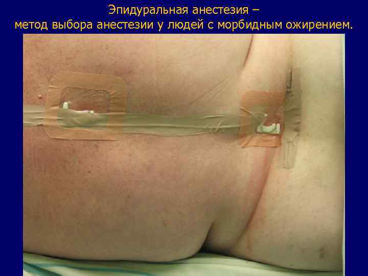 Эпидуральная анестезия – метод выбора анестезии у людей с морбидным ожирением. 