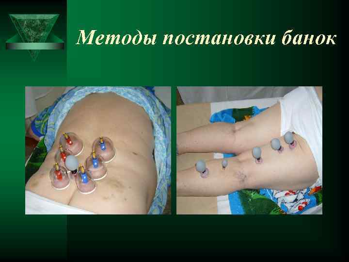 Методы постановки банок 