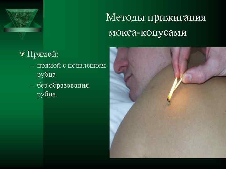 Методы прижигания мокса-конусами Ú Прямой: – прямой с появлением рубца – без образования рубца