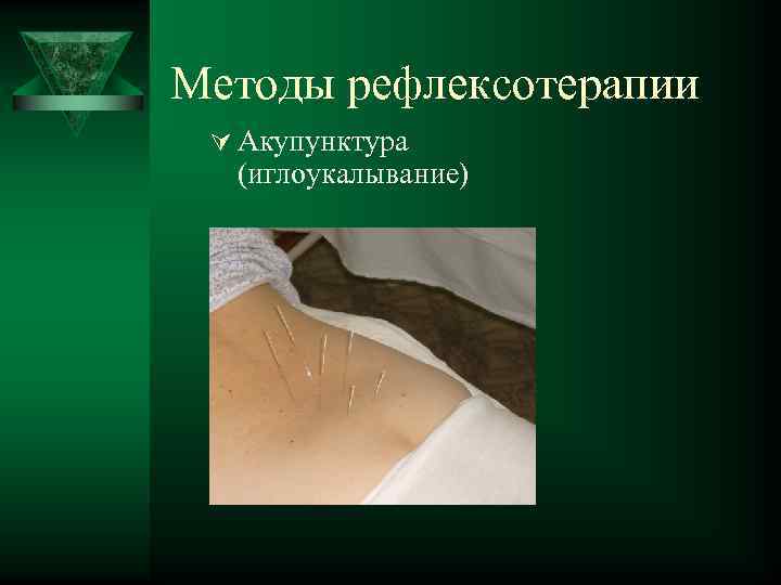 Методы рефлексотерапии Ú Акупунктура (иглоукалывание) 
