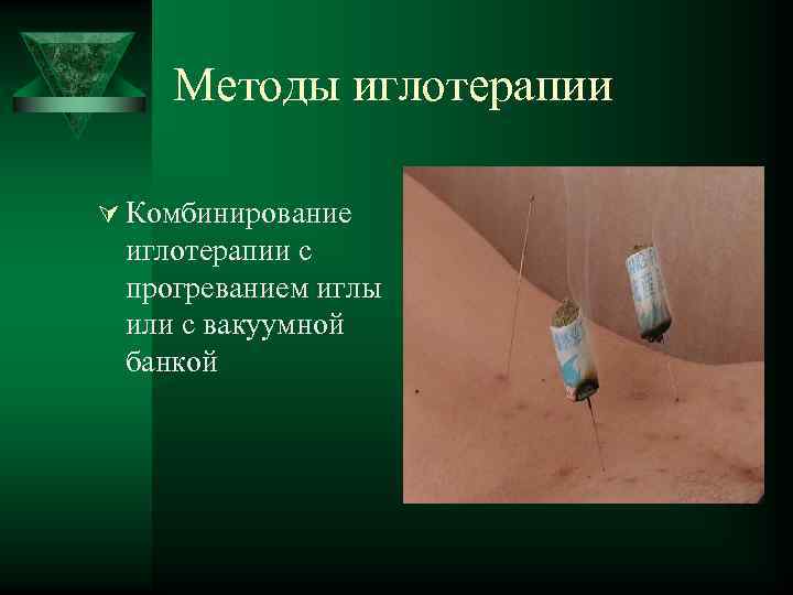 Методы иглотерапии Ú Комбинирование иглотерапии с прогреванием иглы или с вакуумной банкой 