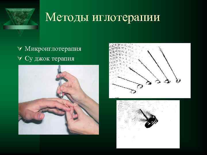 Методы иглотерапии Ú Микроиглотерапия Ú Су джок терапия 