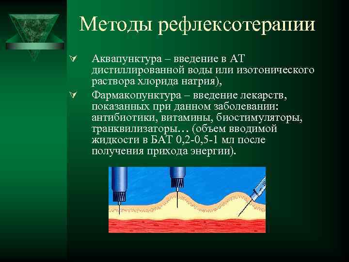 Методы рефлексотерапии Ú Ú Аквапунктура – введение в АТ дистиллированной воды или изотонического раствора