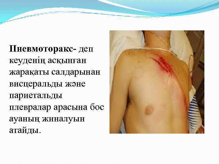 Пневмоторакс- деп кеуденің асқынған жарақаты салдарынан висцеральды және париетальды плевралар арасына бос ауаның жиналуын