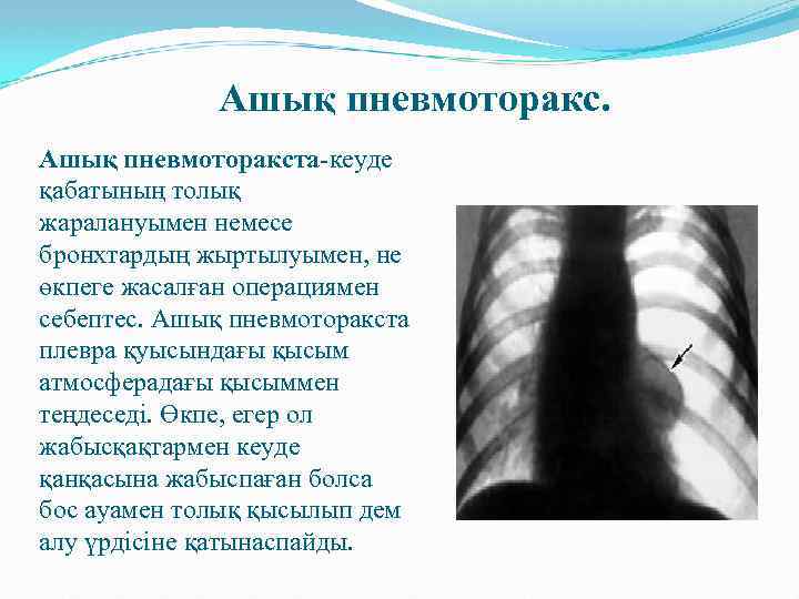 Ашық пневмоторакста-кеуде қабатының толық жаралануымен немесе бронхтардың жыртылуымен, не өкпеге жасалған операциямен себептес. Ашық