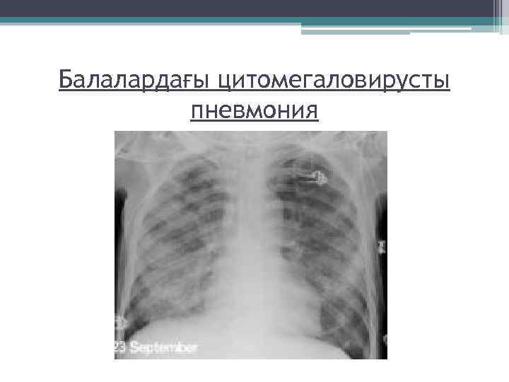 Балалардағы цитомегаловирусты пневмония 