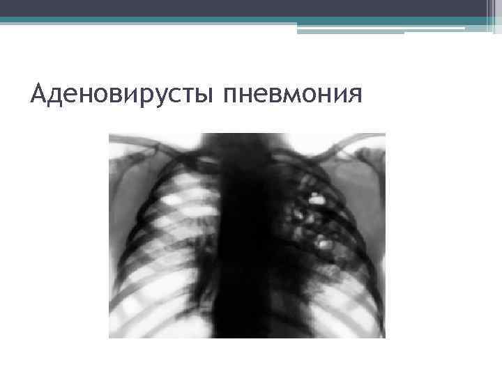 Аденовирусты пневмония 