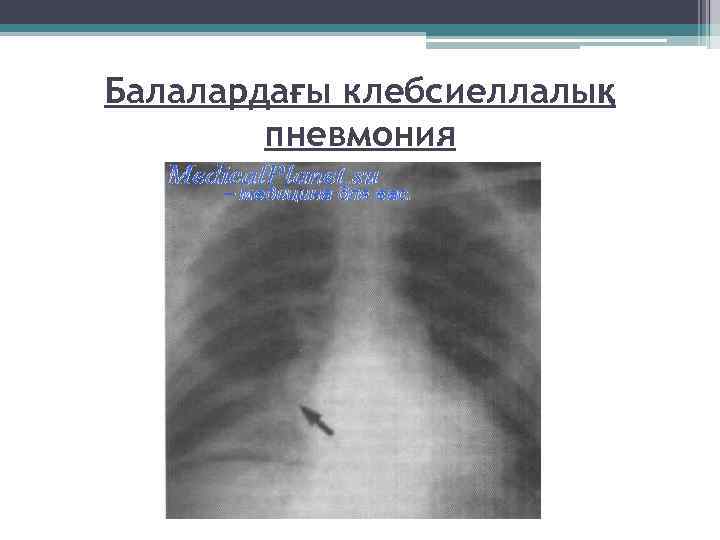 Балалардағы клебсиеллалық пневмония 