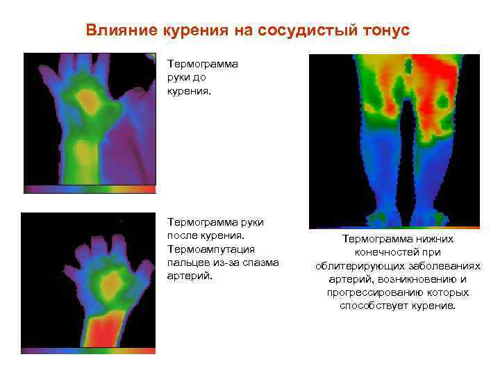 Влияние курения на сосудистый тонус Термограмма руки до курения. Термограмма руки после курения. Термоампутация