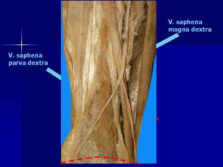 Vena saphena parva. Сафена Магна.