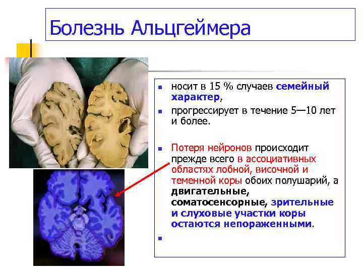Болезнь Альцгеймера n n носит в 15 % случаев семейный характер, прогрессирует в течение