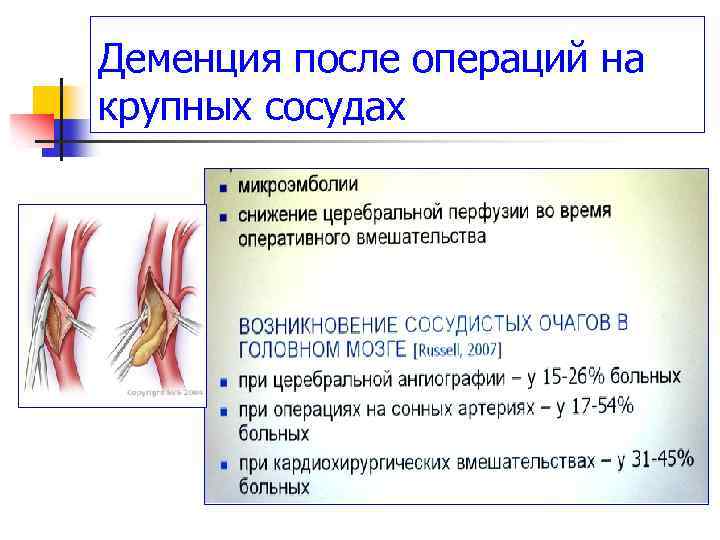 Деменция после операций на крупных сосудах 