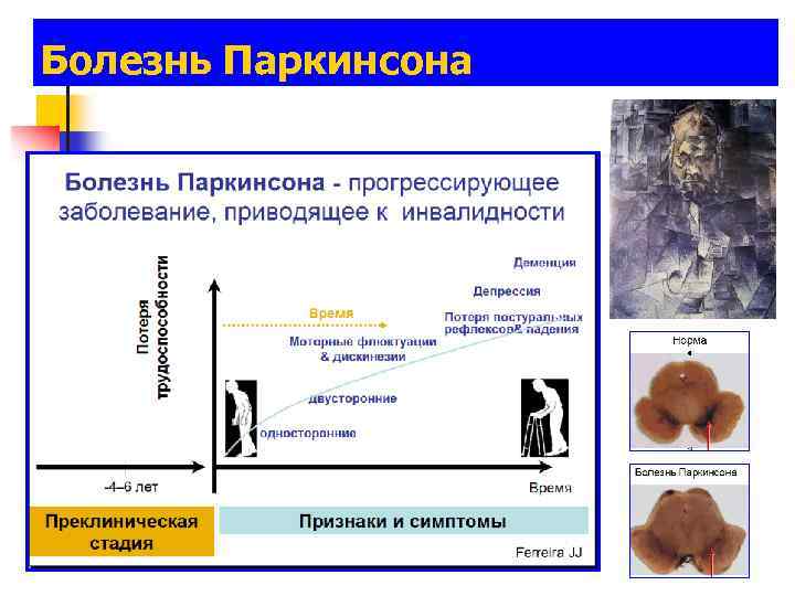 Болезнь Паркинсона 