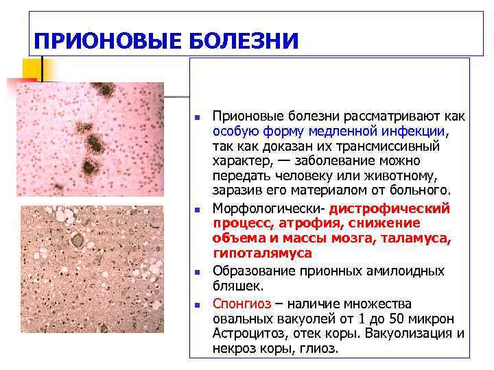 ПРИОНОВЫЕ БОЛЕЗНИ n n Прионовые болезни рассматривают как особую форму медленной инфекции, так как
