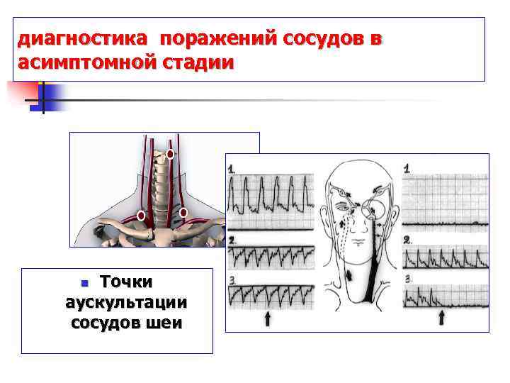диагностика поражений сосудов в асимптомной стадии Точки аускультации сосудов шеи n 