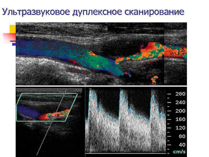 Ультразвуковое дуплексное сканирование 