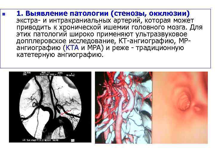 n 1. Выявление патологии (стенозы, окклюзии) экстра- и интракраниальных артерий, которая может приводить к