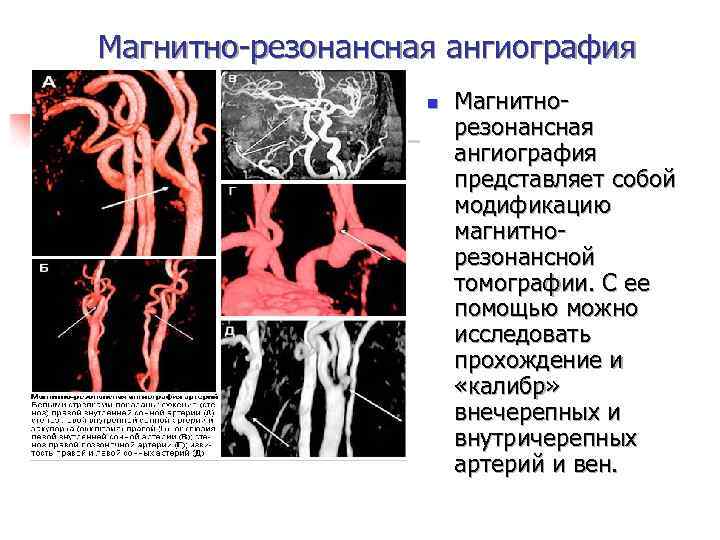Магнитно-резонансная ангиография n Магнитнорезонансная ангиография представляет собой модификацию магнитнорезонансной томографии. С ее помощью можно