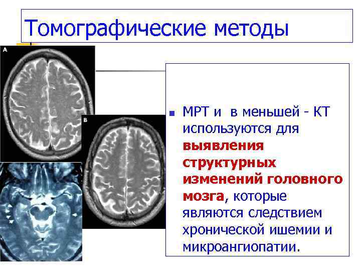Томографические методы n МРТ и в меньшей - КТ используются для выявления структурных изменений