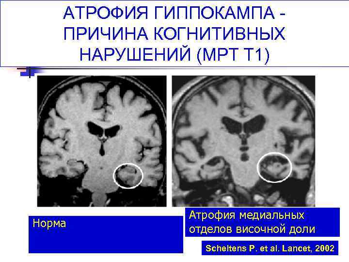 Атрофия головного мозга. Гиппокамп норма мрт. Атрофия гиппокампа на мрт. Атрофия височной доли кт. Гиппокамп на кт.