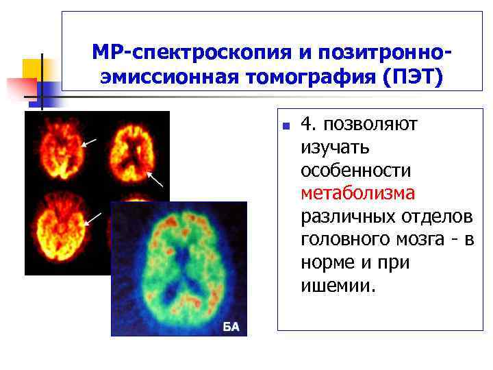 MP-спектроскопия и позитронноэмиссионная томография (ПЭТ) n 4. позволяют изучать особенности метаболизма различных отделов головного
