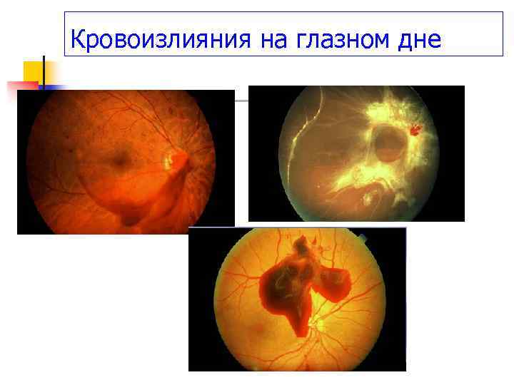 Кровоизлияния на глазном дне 
