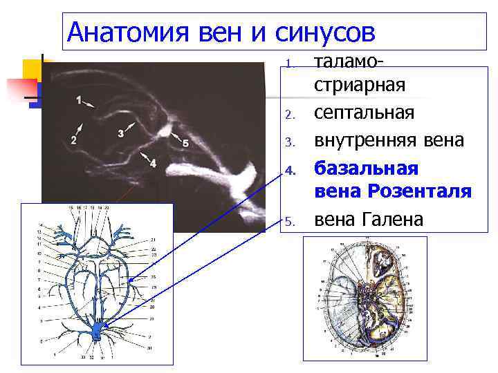 Вене галена. Вена Галена и Вена Розенталя. Вена Розенталя анатомия на УЗИ. Вена Галена головного мозга.