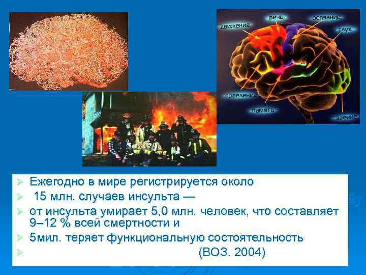 Ежегодно в мире регистрируется около 15 млн. случаев инсульта — от инсульта умирает 5,