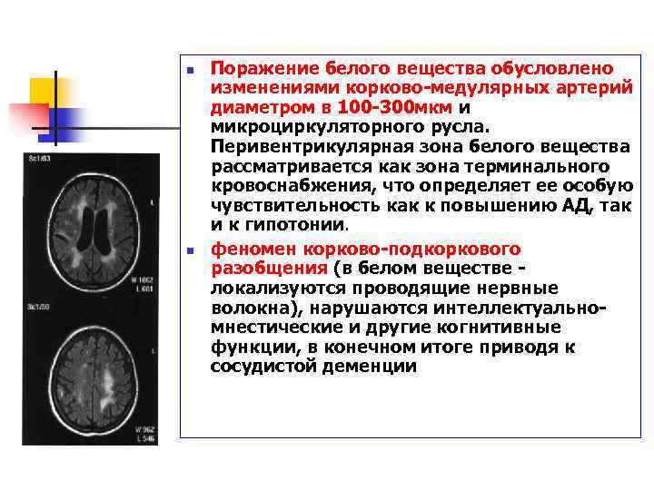 Очаговые изменения головного мозга сосудистого генеза. Очаги в белом веществе.