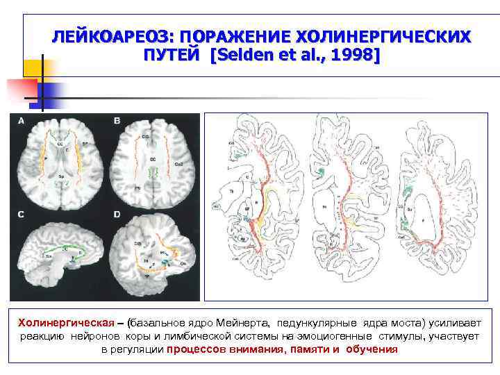 Лейкоареоз головного