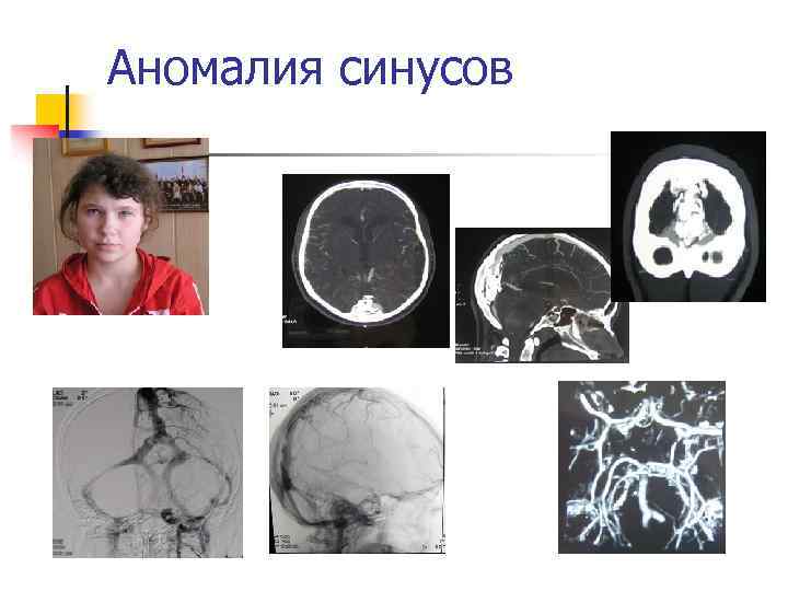 Аномалия синусов 