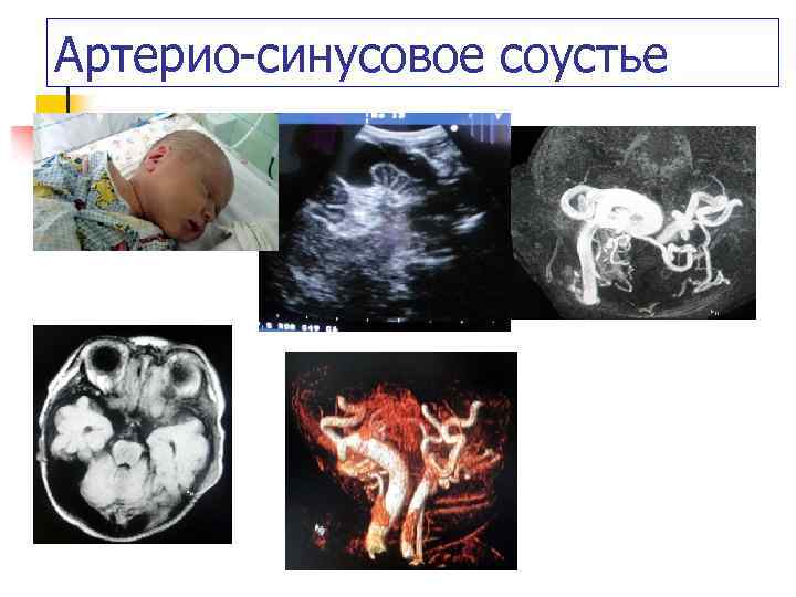 Артерио-синусовое соустье 