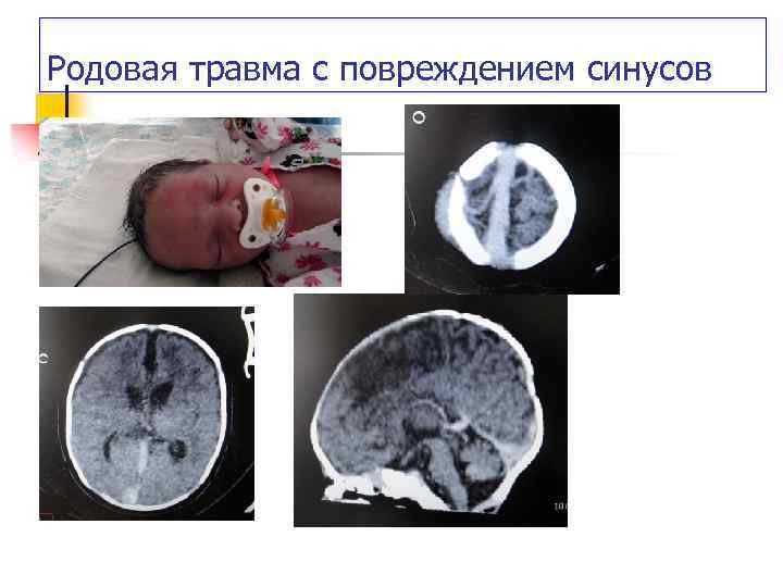 Родовая травма с повреждением синусов 