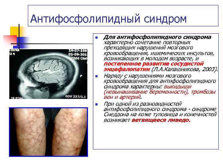 Антифосфолипидный синдром n n n Для антифосфолипидного синдрома характерно сочетание повторных преходящих нарушений мозгового