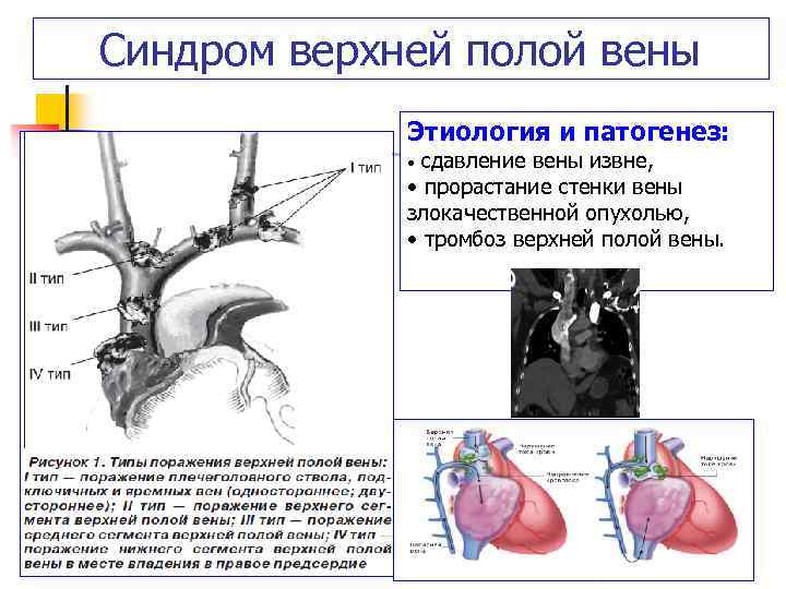 Острые тромбозы системы нижней полой вены презентация