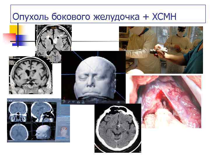Опухоль бокового желудочка + ХСМН 