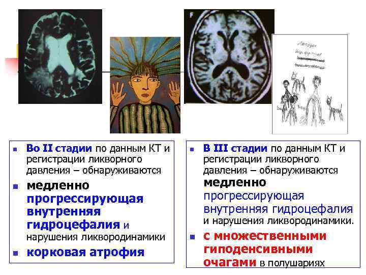 n n Во II стадии по данным КТ и регистрации ликворного давления – обнаруживаются