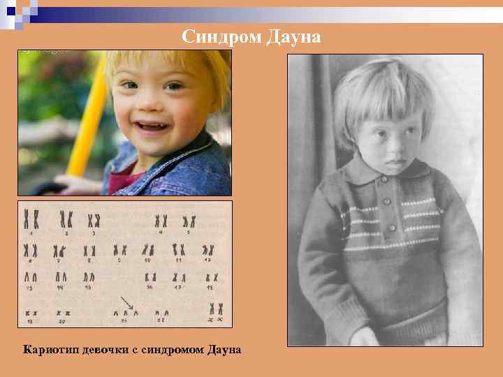 Синдром Дауна Кариотип девочки с синдромом Дауна 