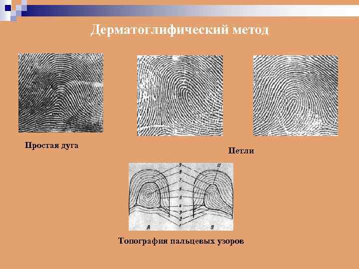 Дерматоглифический метод Простая дуга Петли Топография пальцевых узоров 