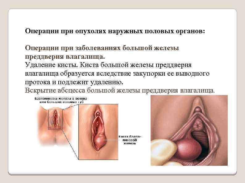 Операции при опухолях наружных половых органов: Операции при заболеваниях большой железы преддверия влагалища. Удаление