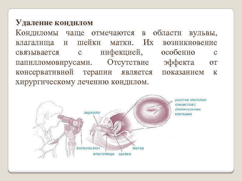 Удаление кондилом Кондиломы чаще отмечаются в области вульвы, влагалища и шейки матки. Их возникновение