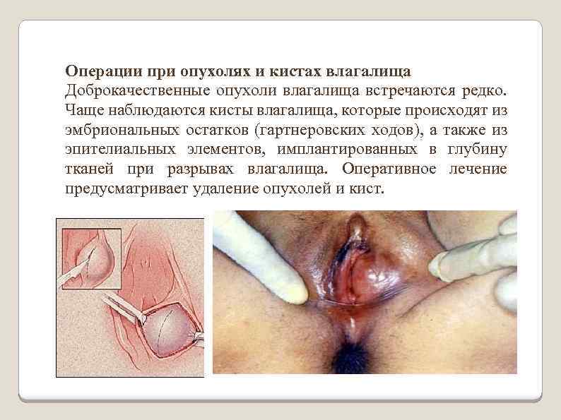 Операции при опухолях и кистах влагалища Доброкачественные опухоли влагалища встречаются редко. Чаще наблюдаются кисты