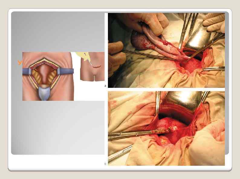 Удаление маточных труб 