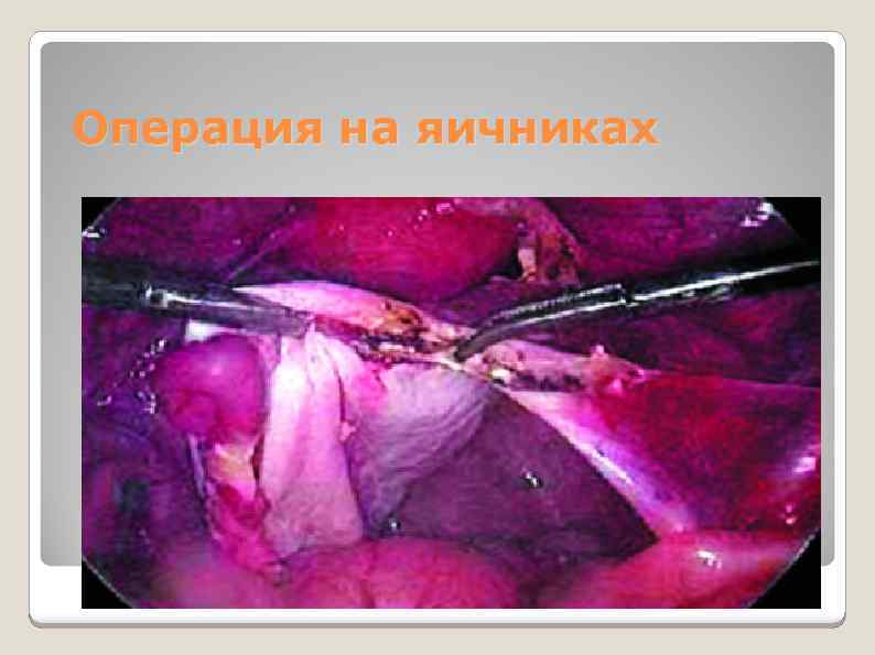 Операция на яичниках 