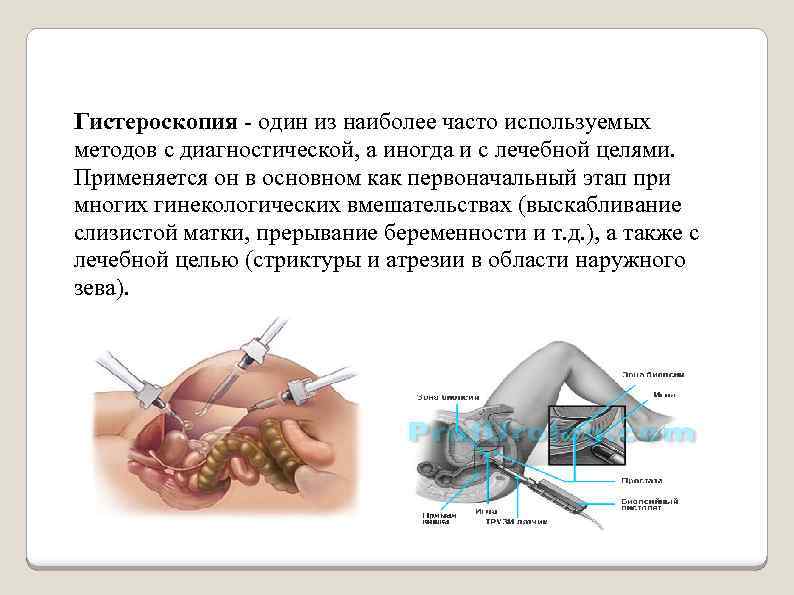 Гистероскопия один из наиболее часто используемых методов с диагностической, а иногда и с лечебной