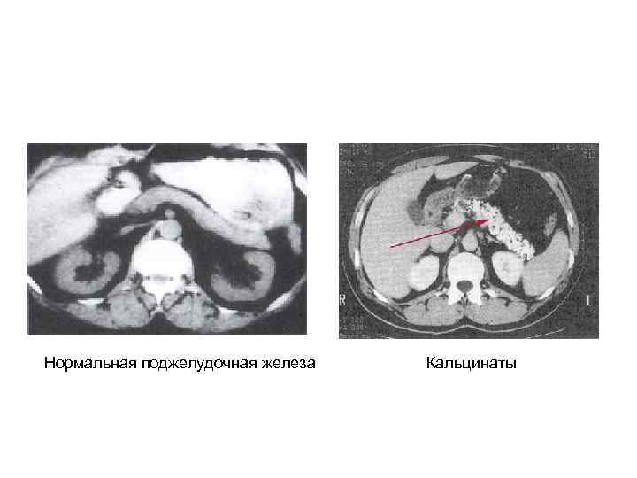 Нормальная поджелудочная железа Кальцинаты 