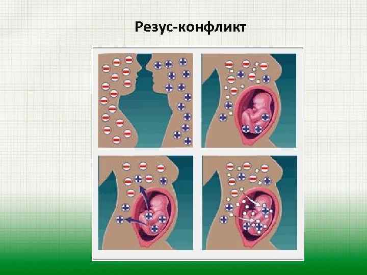 Резус-конфликт 