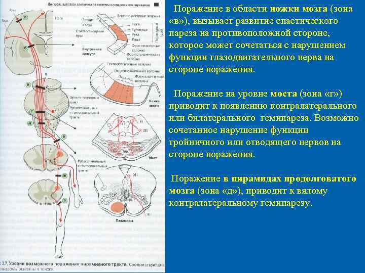  Поражение в области ножки мозга (зона «в» ), вызывает развитие спастического пареза на