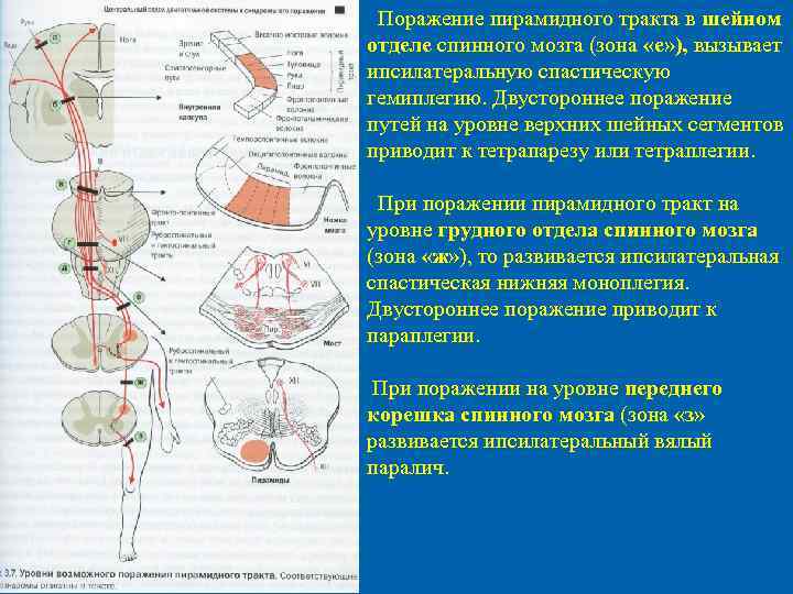  Поражение пирамидного тракта в шейном отделе спинного мозга (зона «е» ), вызывает ипсилатеральную